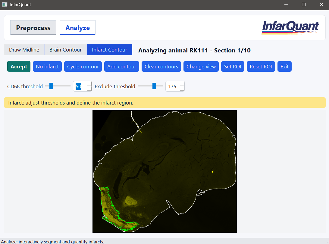 InfarQuant contour editing for infarct segmentation